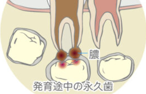 乳歯の虫歯が発育途中の永久歯に影響する図解